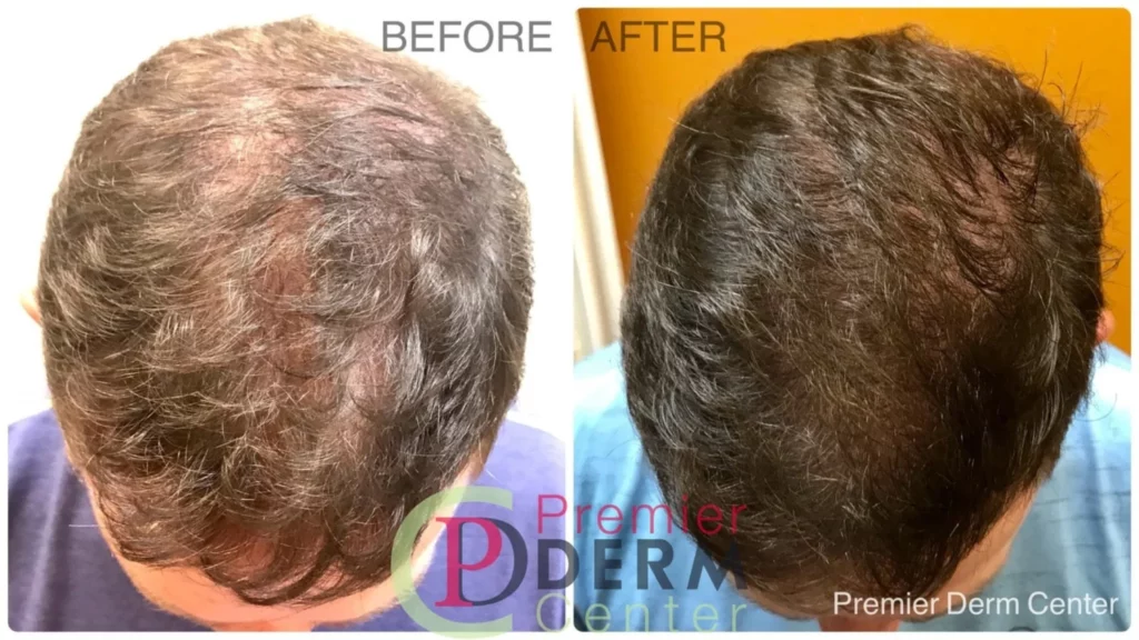hair-restore ,Premier Derm Center PLLC | Houston, TX